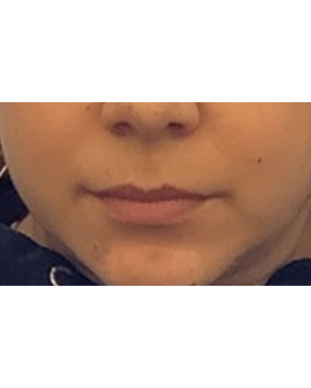 Before mini lip plump at Reviv Beauty Med Spa in Sanford FL – natural lips without filler