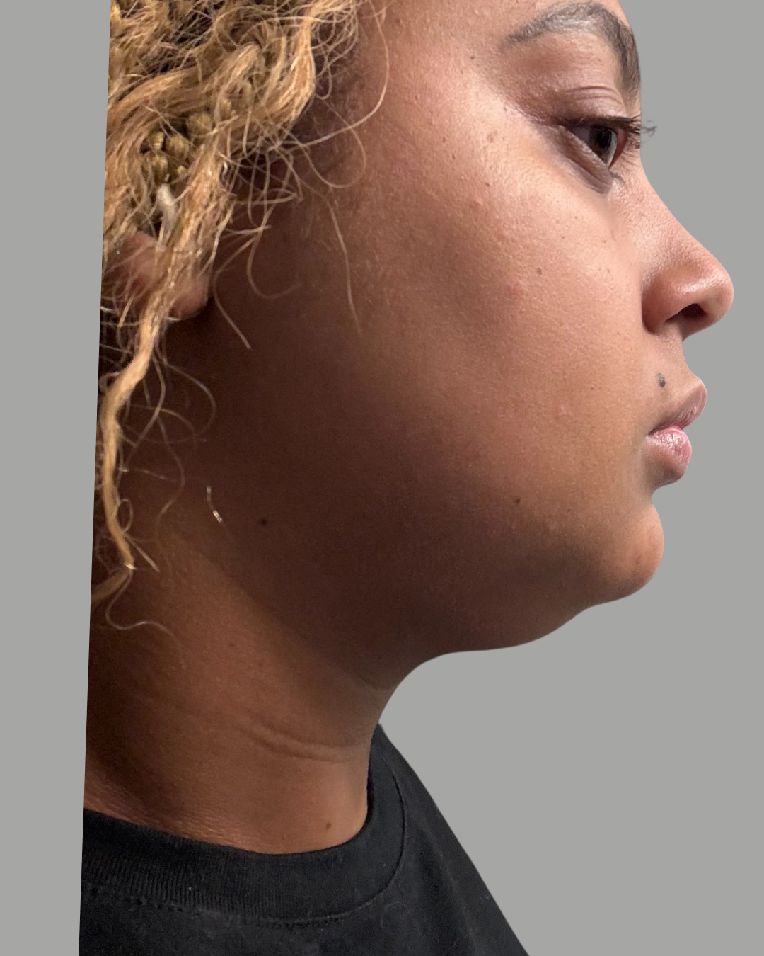 After photo showing improved jawline following Kybella double chin reduction