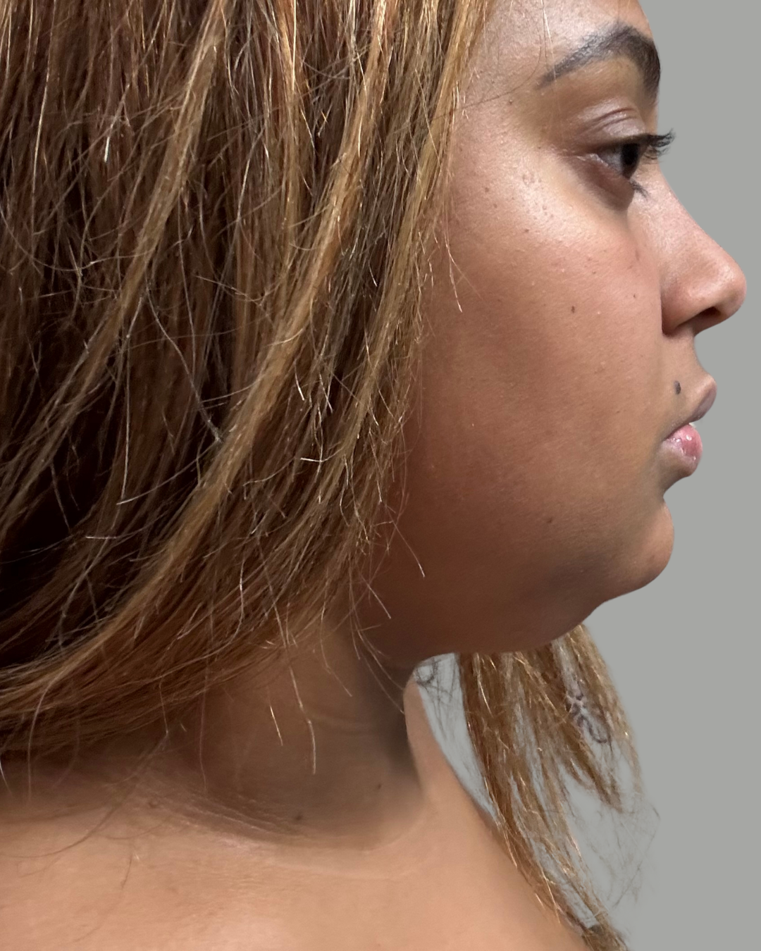 Side profile showing submental fullness before double chin reduction with Kybella