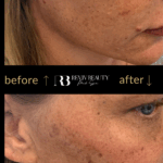Before and after results of cheek contouring using dermal filler on female client at Reviv Beauty Med Spa in Sanford FL.