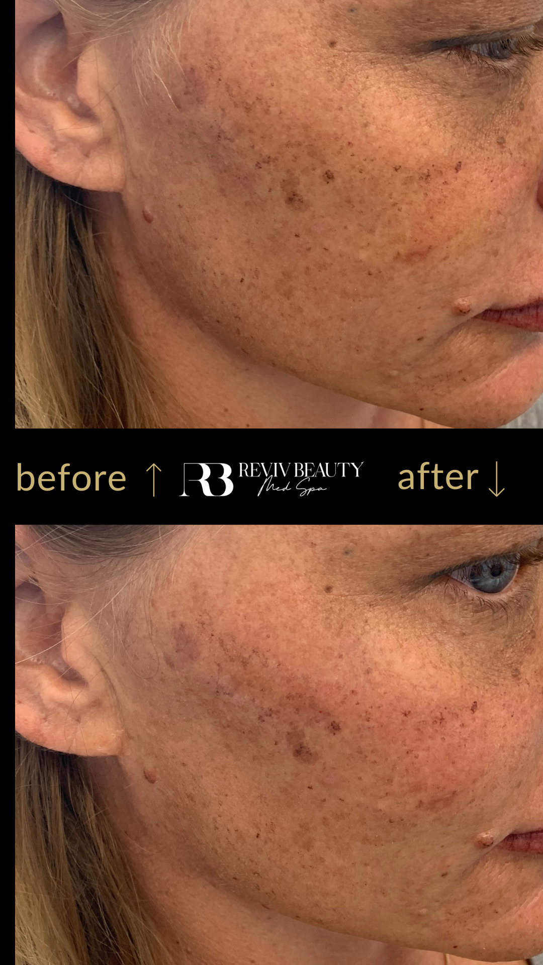 Before and after results of cheek contouring using dermal filler on female client at Reviv Beauty Med Spa in Sanford FL.