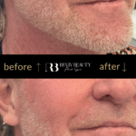 Before and after jawline contouring using dermal filler on male client at Reviv Beauty Med Spa in Sanford FL.