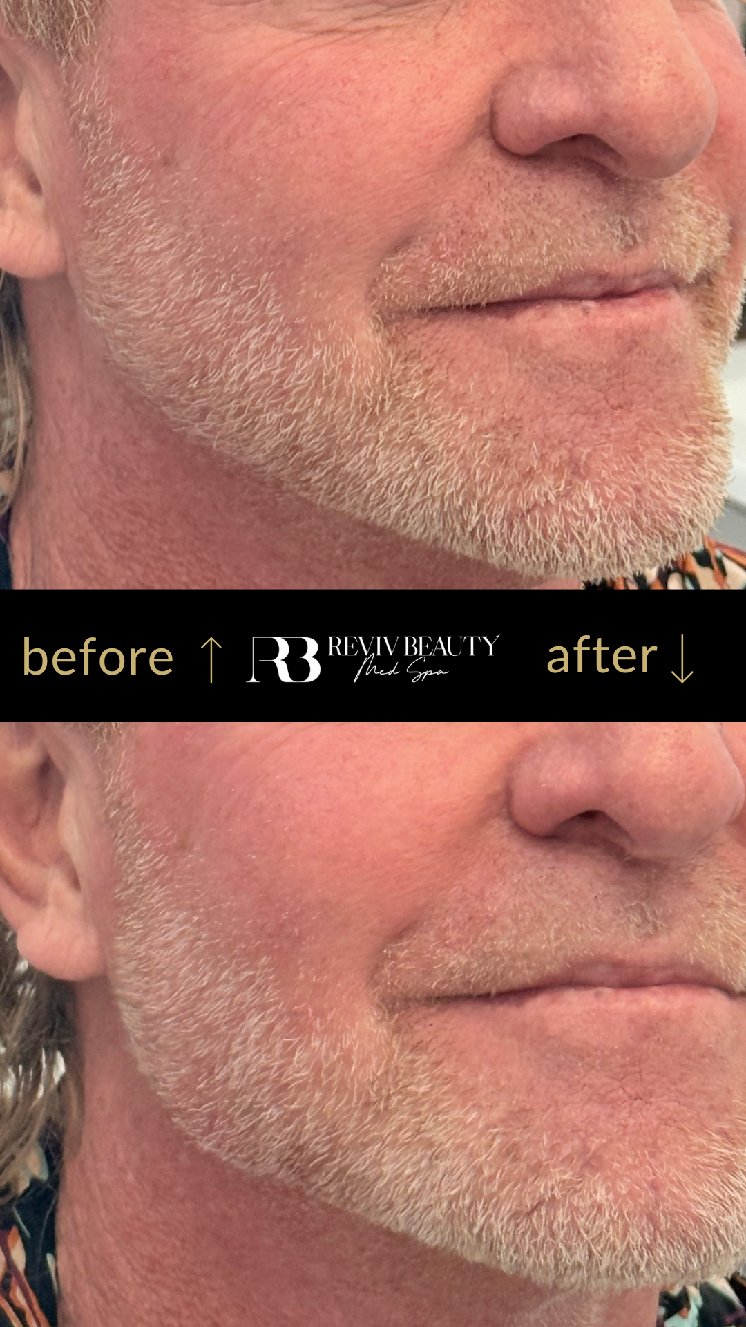Before and after jawline contouring using dermal filler on male client at Reviv Beauty Med Spa in Sanford FL.
