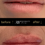 revivbeauty-lip-filler-before-after-balanced-shape-sanford-fl