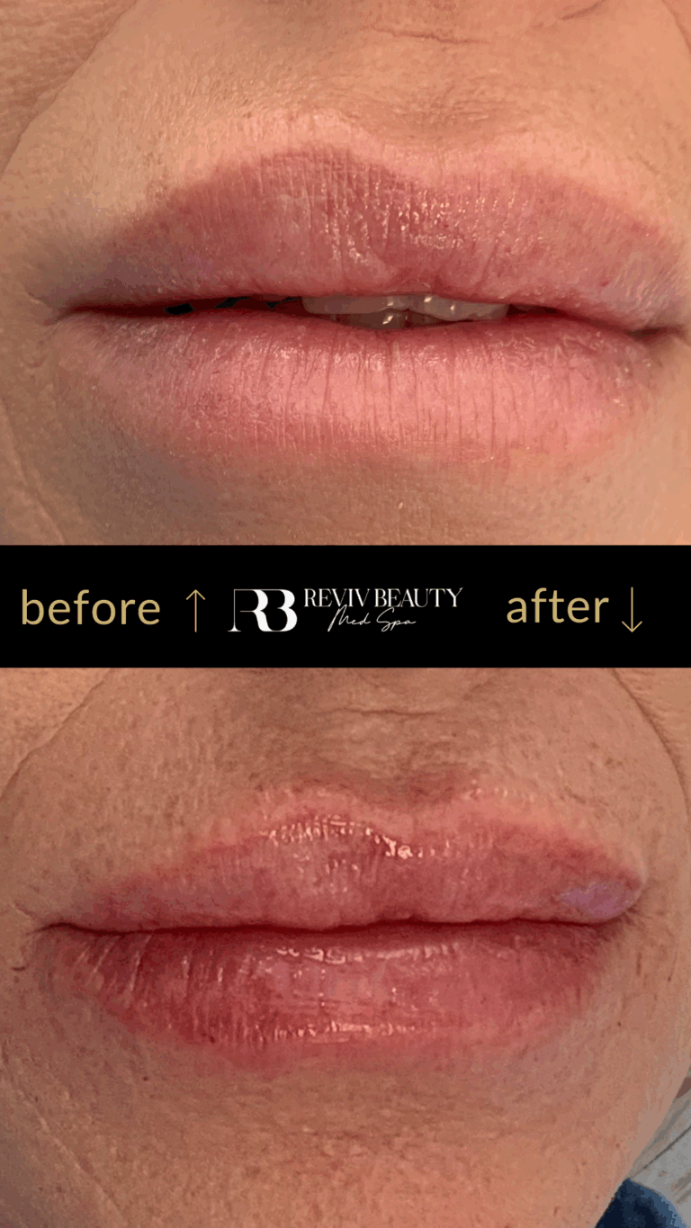 revivbeauty-lip-filler-before-after-balanced-shape-sanford-fl