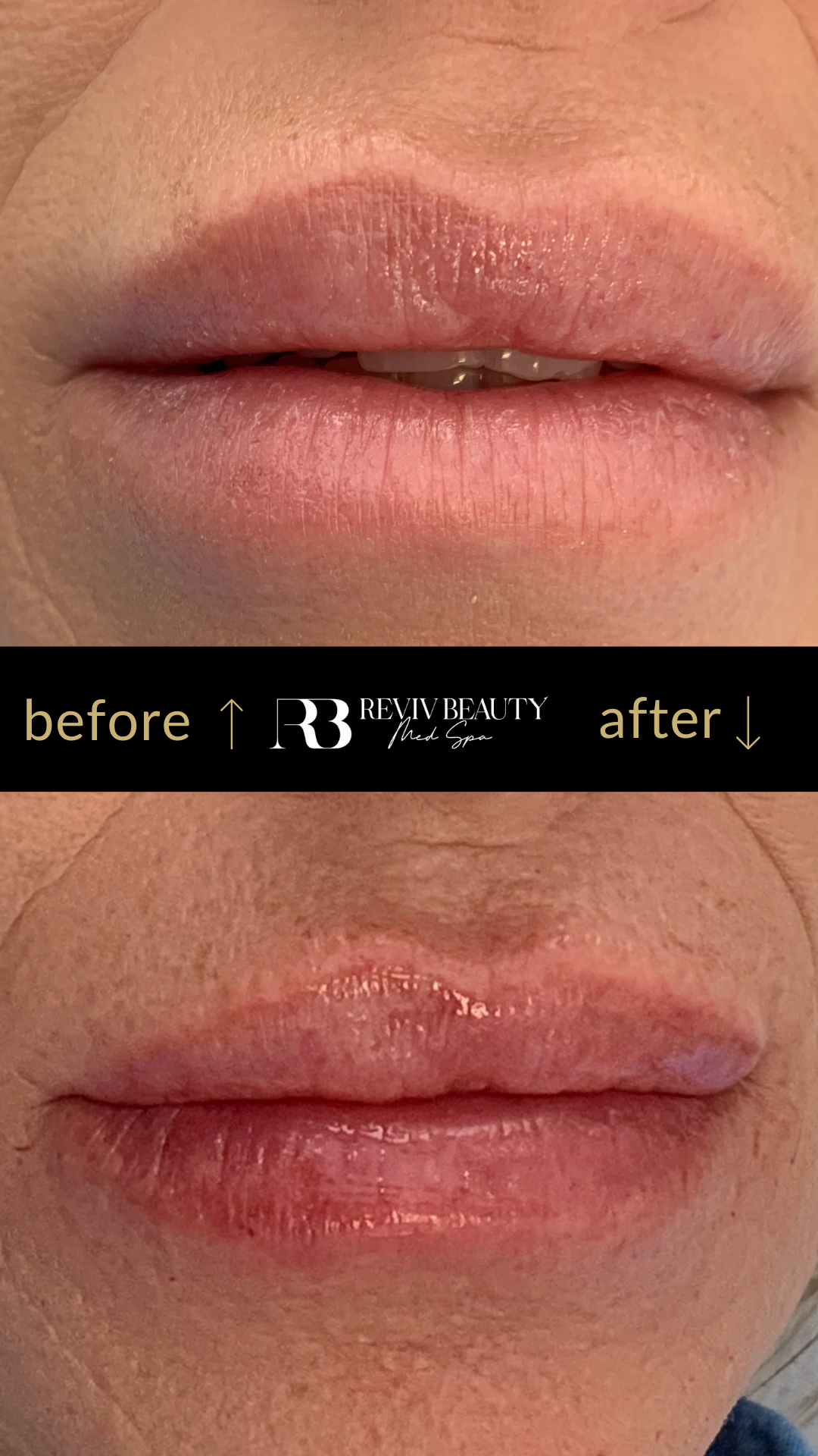 revivbeauty-lip-filler-before-after-balanced-shape-sanford-fl