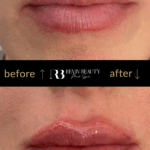 revivbeauty-lip-filler-before-after-defined-lip-border-sanford-fl