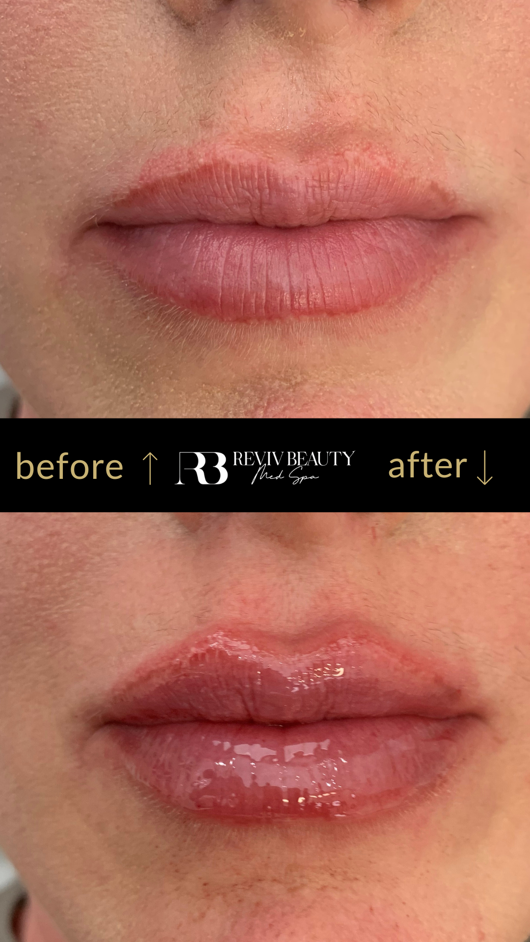 revivbeauty-lip-filler-before-after-defined-lip-border-sanford-fl