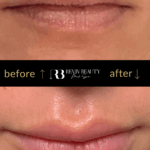 revivbeauty-lip-filler-before-after-hydrated-look-sanford-fl