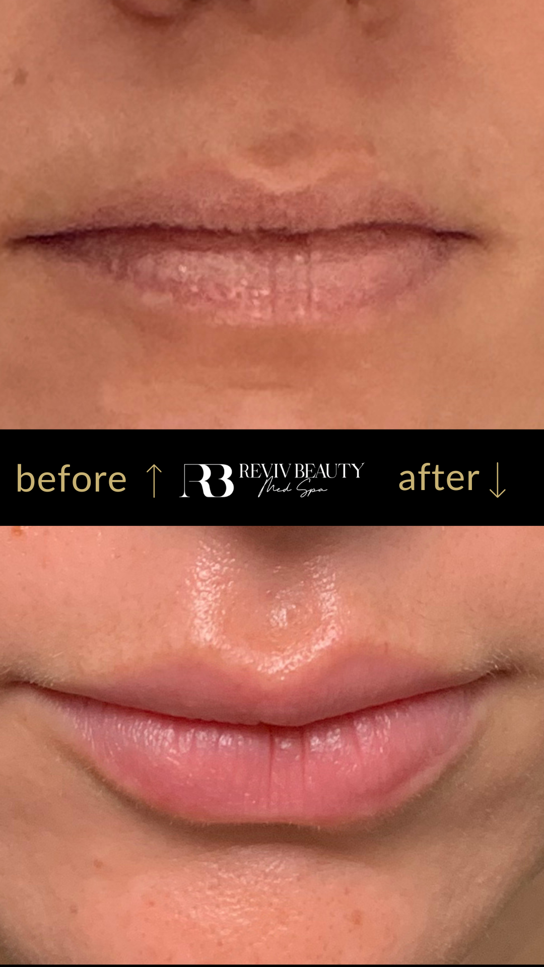 revivbeauty-lip-filler-before-after-hydrated-look-sanford-fl