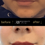revivbeauty-lip-filler-before-after-lip-symmetry-correction-sanford-fl