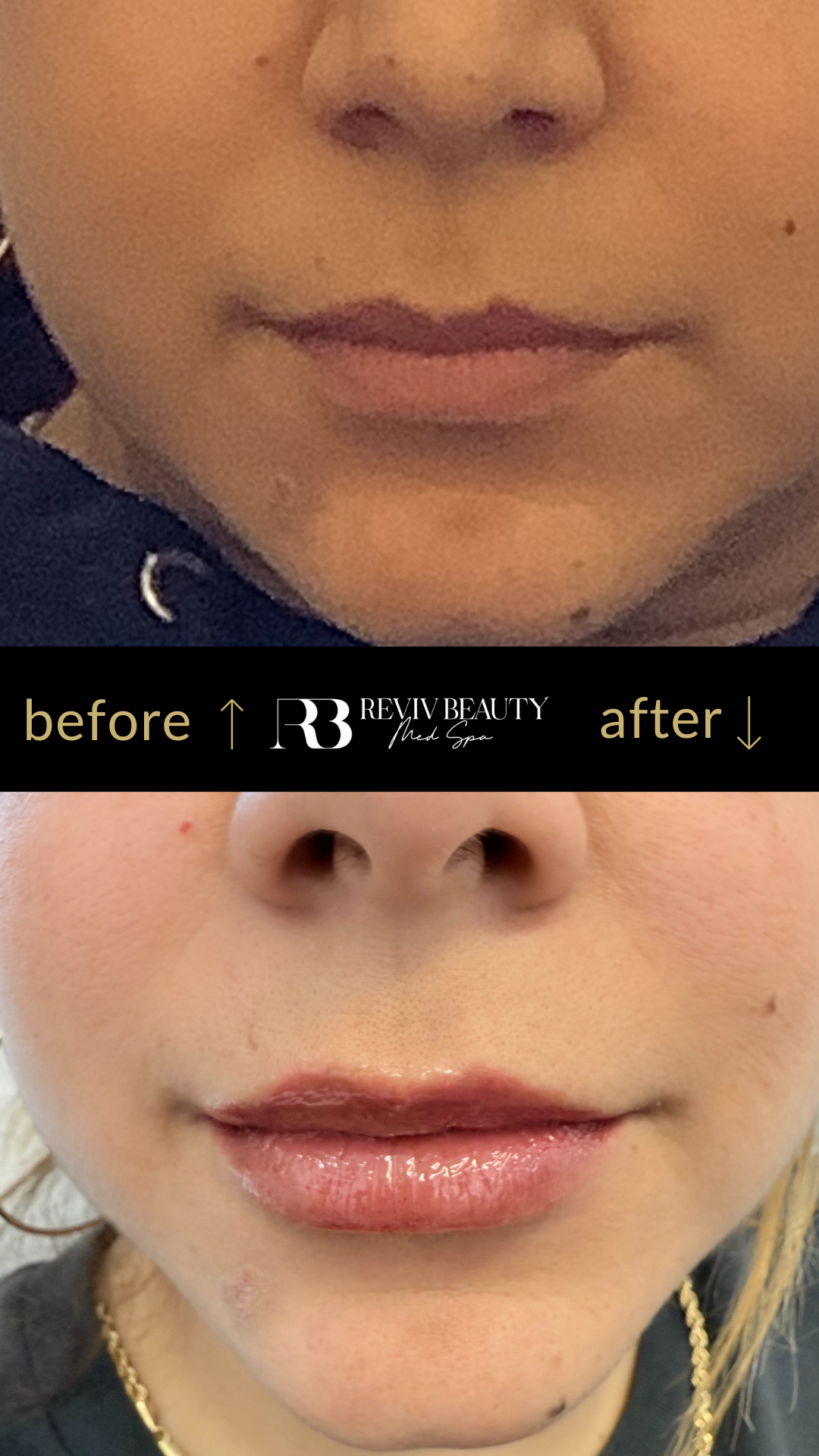 revivbeauty-lip-filler-before-after-lip-symmetry-correction-sanford-fl