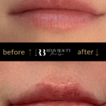 revivbeauty-lip-filler-before-after-natural-volume-sanford-fl