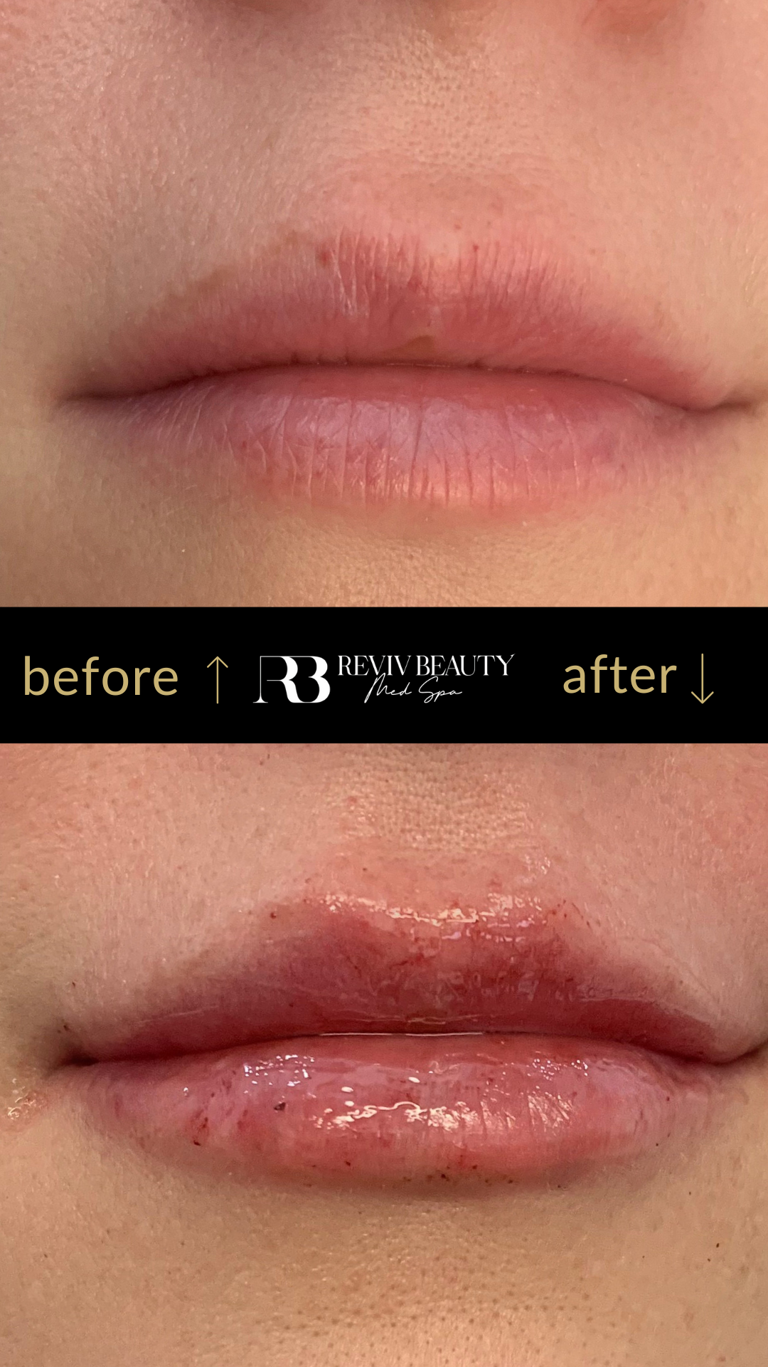 revivbeauty-lip-filler-before-after-natural-volume-sanford-fl