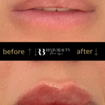 revivbeauty-lip-filler-before-after-soft-pout-sanford-fl