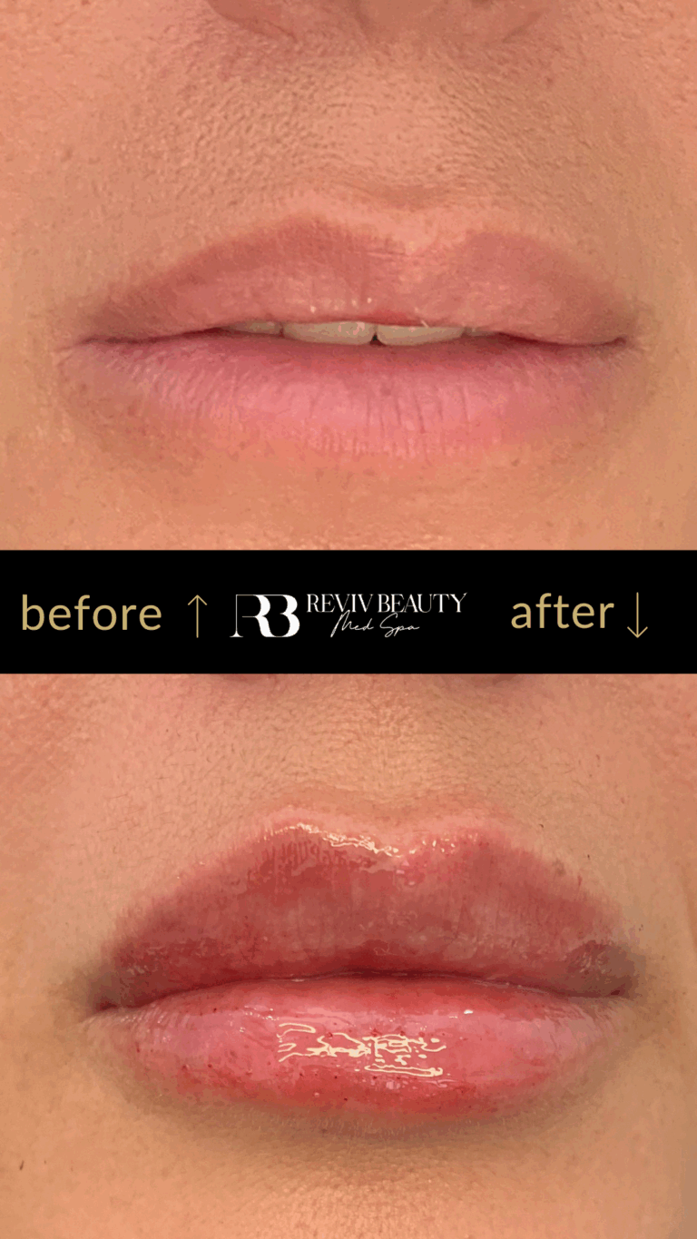 revivbeauty-lip-filler-before-after-soft-pout-sanford-fl