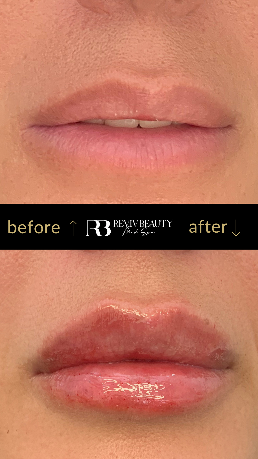 revivbeauty-lip-filler-before-after-soft-pout-sanford-fl