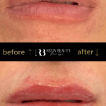 revivbeauty-lip-filler-before-after-subtle-results-sanford-fl