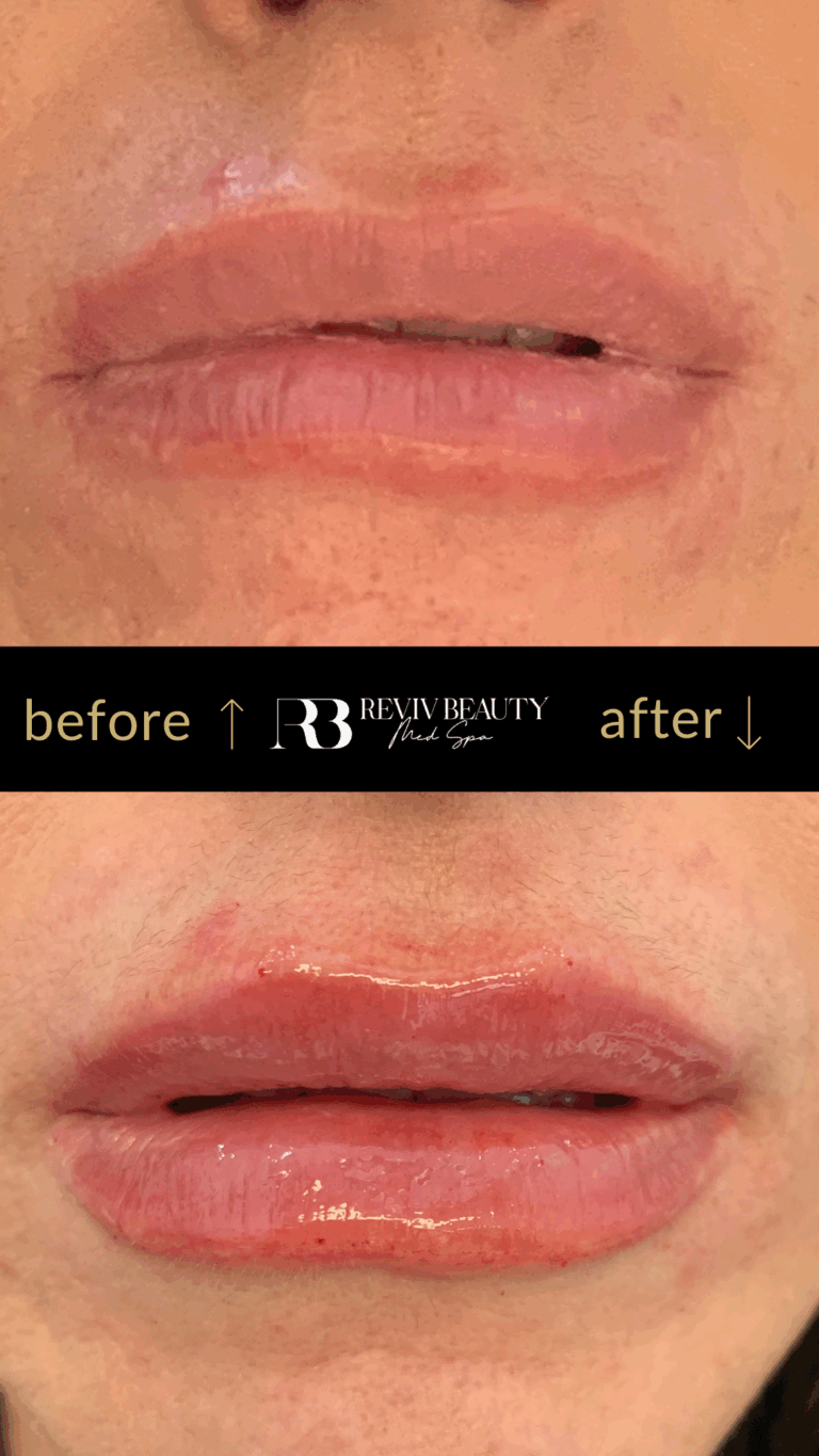 revivbeauty-lip-filler-before-after-subtle-results-sanford-fl