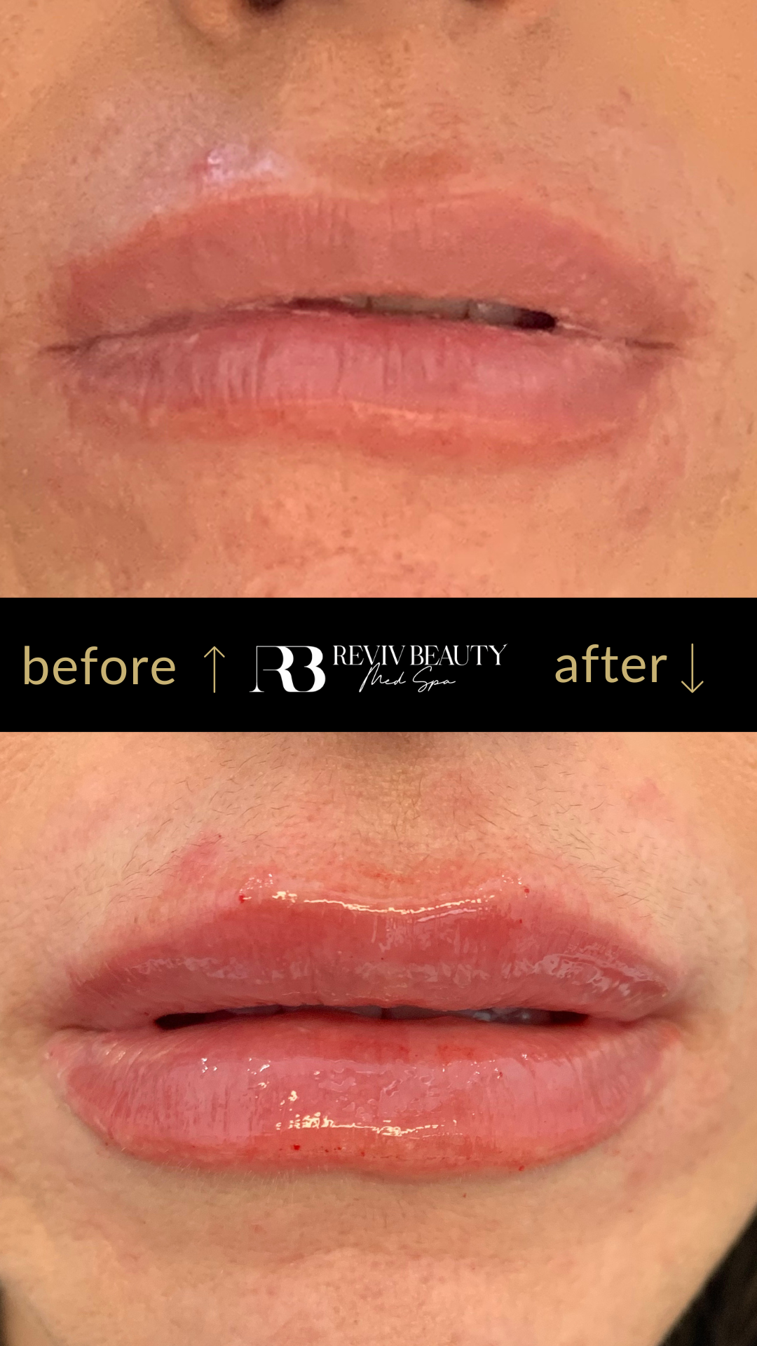 revivbeauty-lip-filler-before-after-subtle-results-sanford-fl