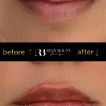 revivbeauty-lip-filler-before-after-upper-lip-enhancement-sanford-fl