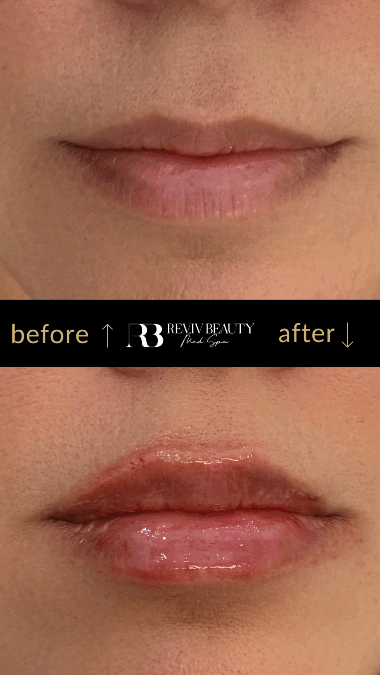 revivbeauty-lip-filler-before-after-upper-lip-enhancement-sanford-fl
