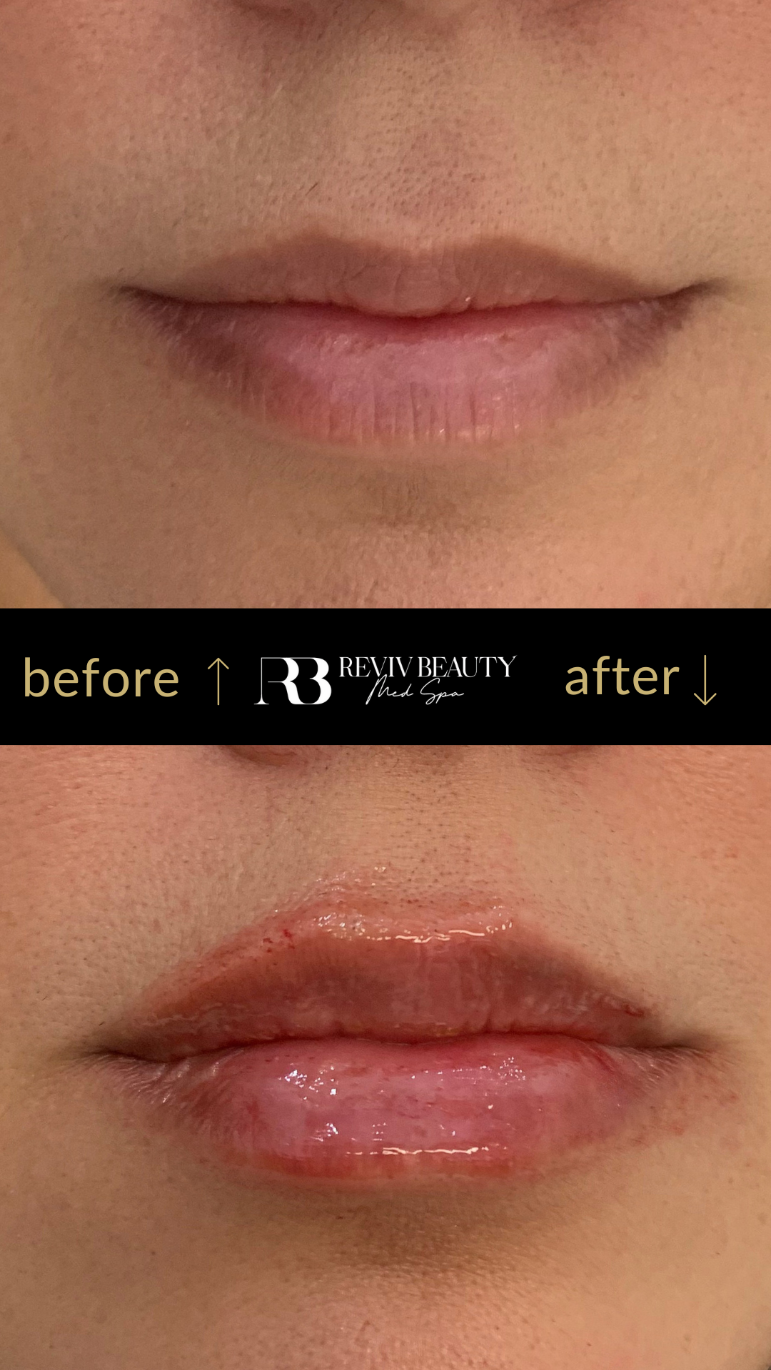 revivbeauty-lip-filler-before-after-upper-lip-enhancement-sanford-fl