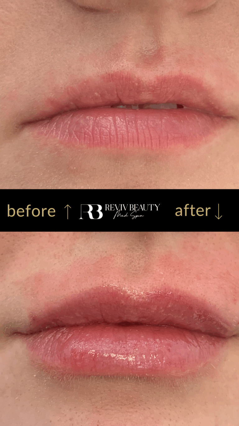 revivbeauty-lip-filler-before-after-volume-boost-sanford-fl