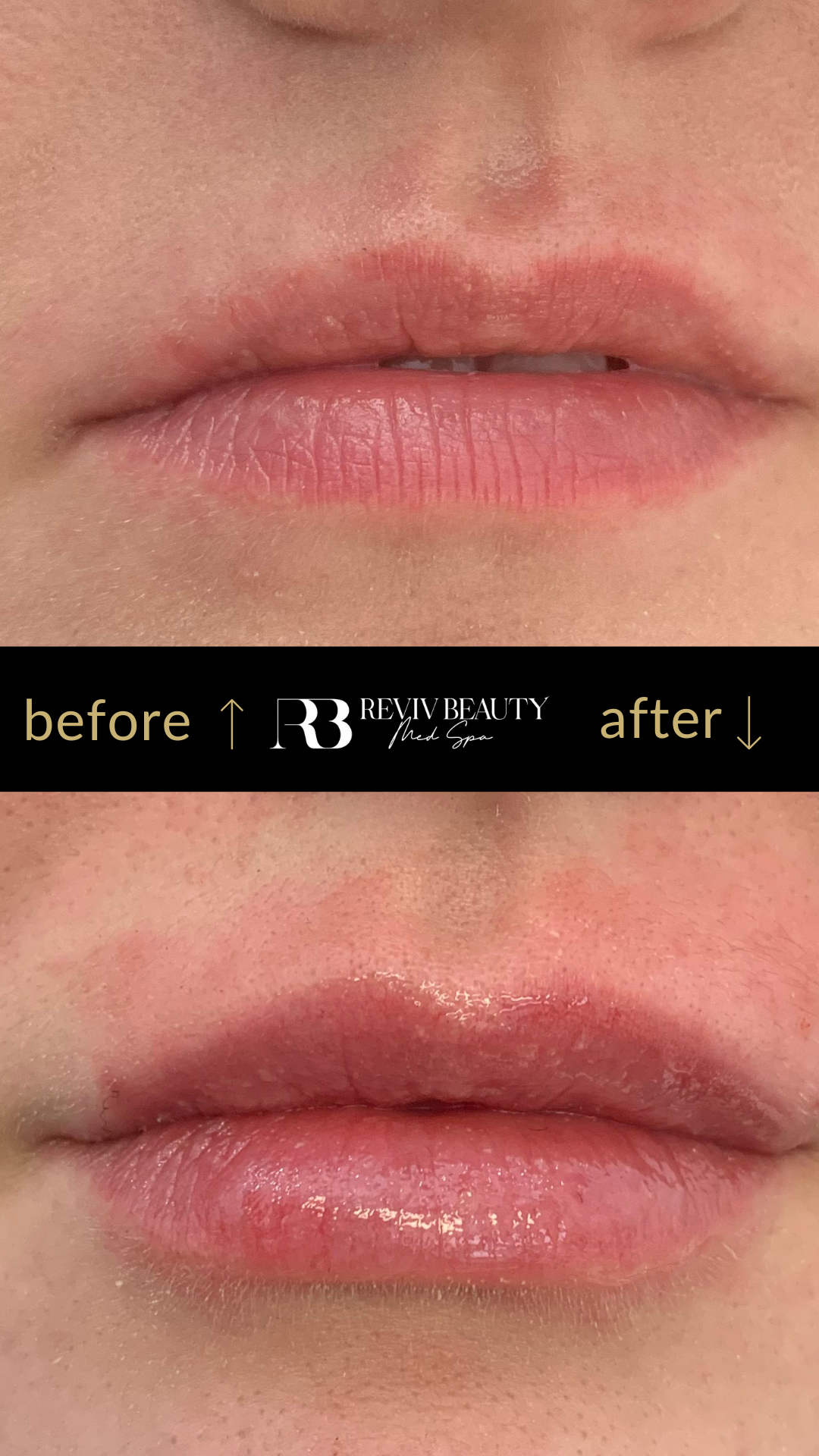 revivbeauty-lip-filler-before-after-volume-boost-sanford-fl