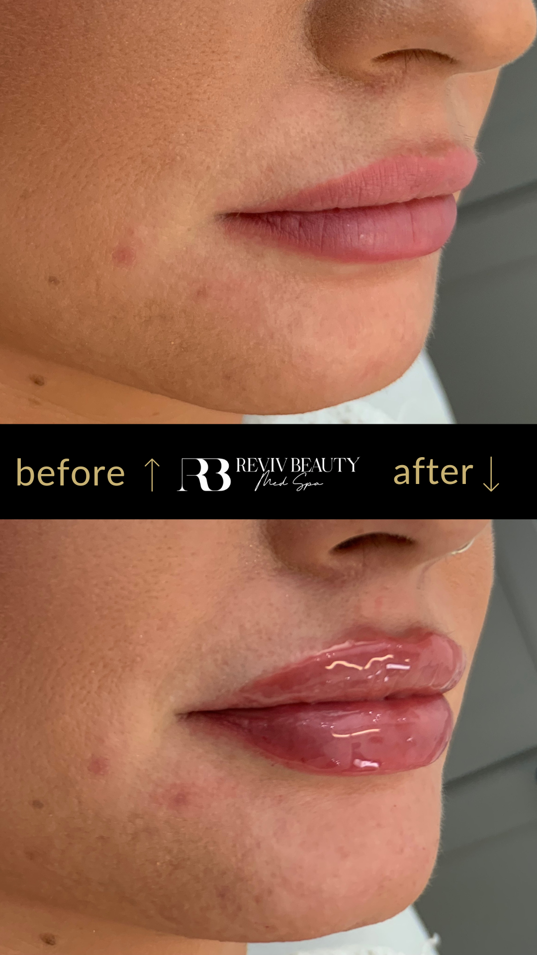 Before and after lip filler treatment at Reviv Beauty Med Spa in Sanford, FL for natural volume and definition