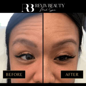 Botox Sanford FL 4 Before and after Botox treatment at Reviv Beauty Med Spa in Sanford, FL showing lifted eyebrows and smoother forehead lines.