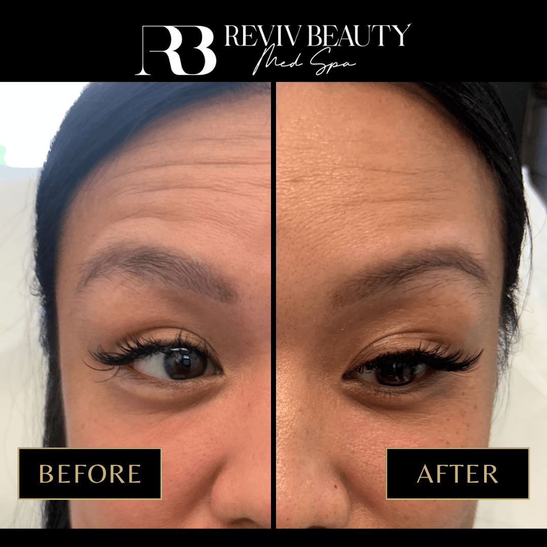 Before and after Botox treatment at Reviv Beauty Med Spa in Sanford, FL showing lifted eyebrows and smoother forehead lines.