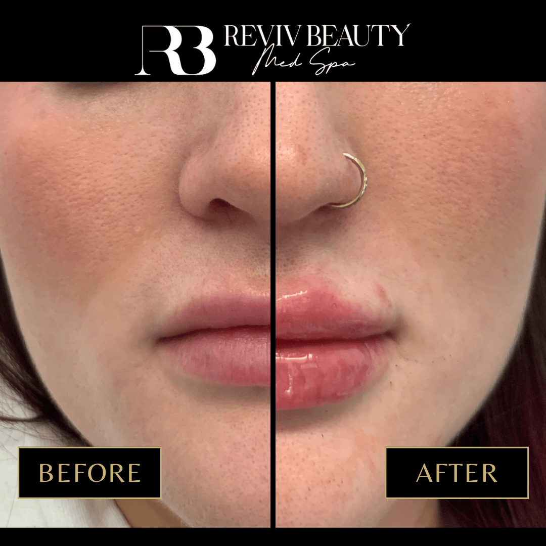 Before and after lip filler at Reviv Beauty Med Spa in Sanford, FL showing natural volume enhancement with Juvederm.