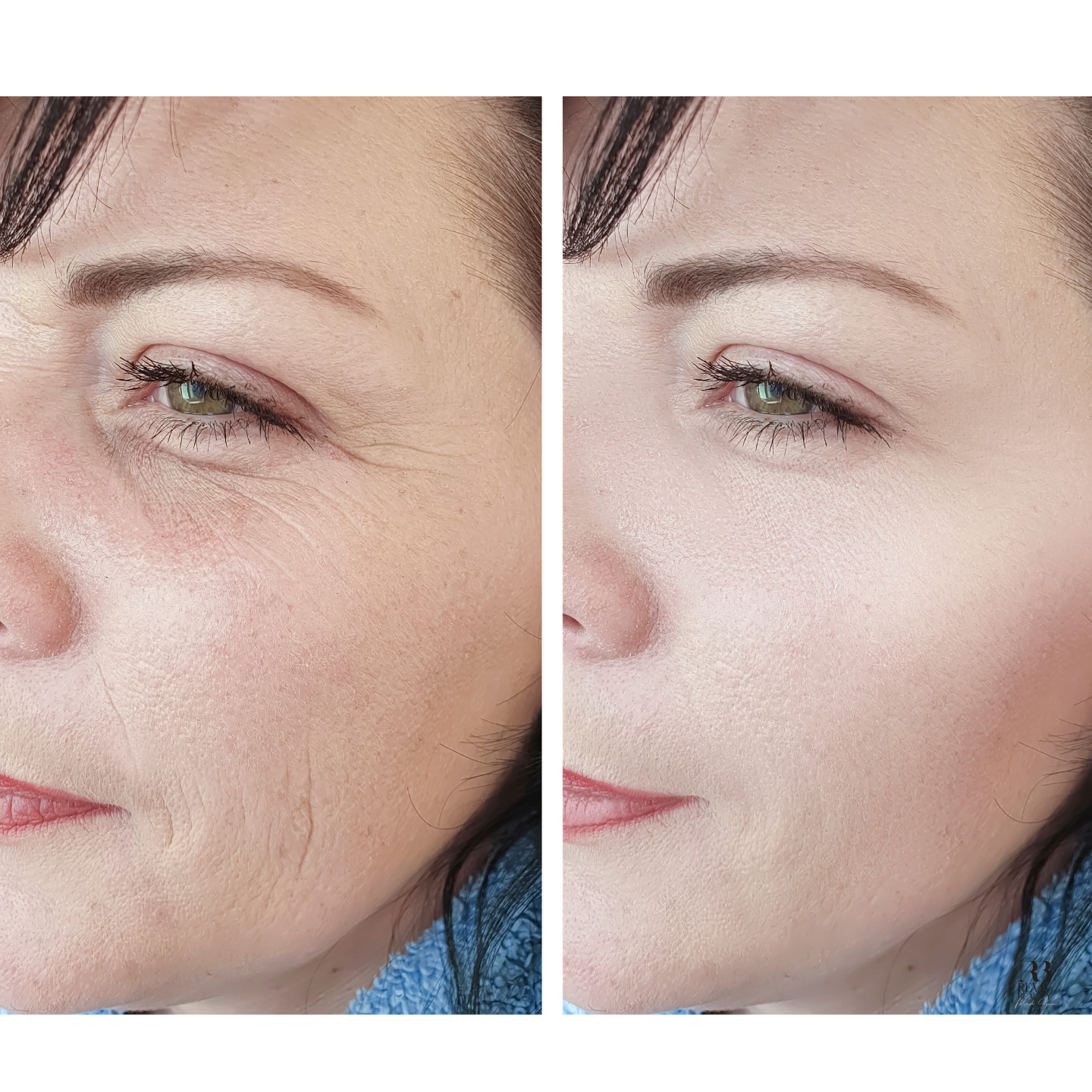 Before and after PDGF under-eye treatment results showing reduced dark circles and smoother skin at Reviv Beauty Med Spa Sanford FL.