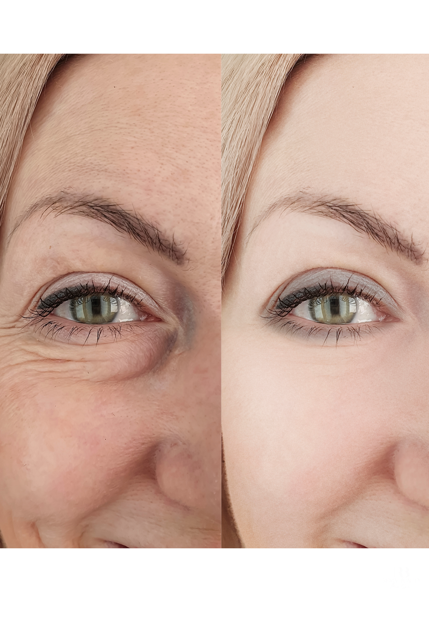 Close-up of fine lines and crow’s feet around the eye before skin booster treatment at Reviv Beauty Med Spa in Sanford, FL.