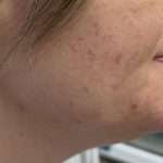 Female patient side profile before Kybella treatment showing submental fullness under the chin