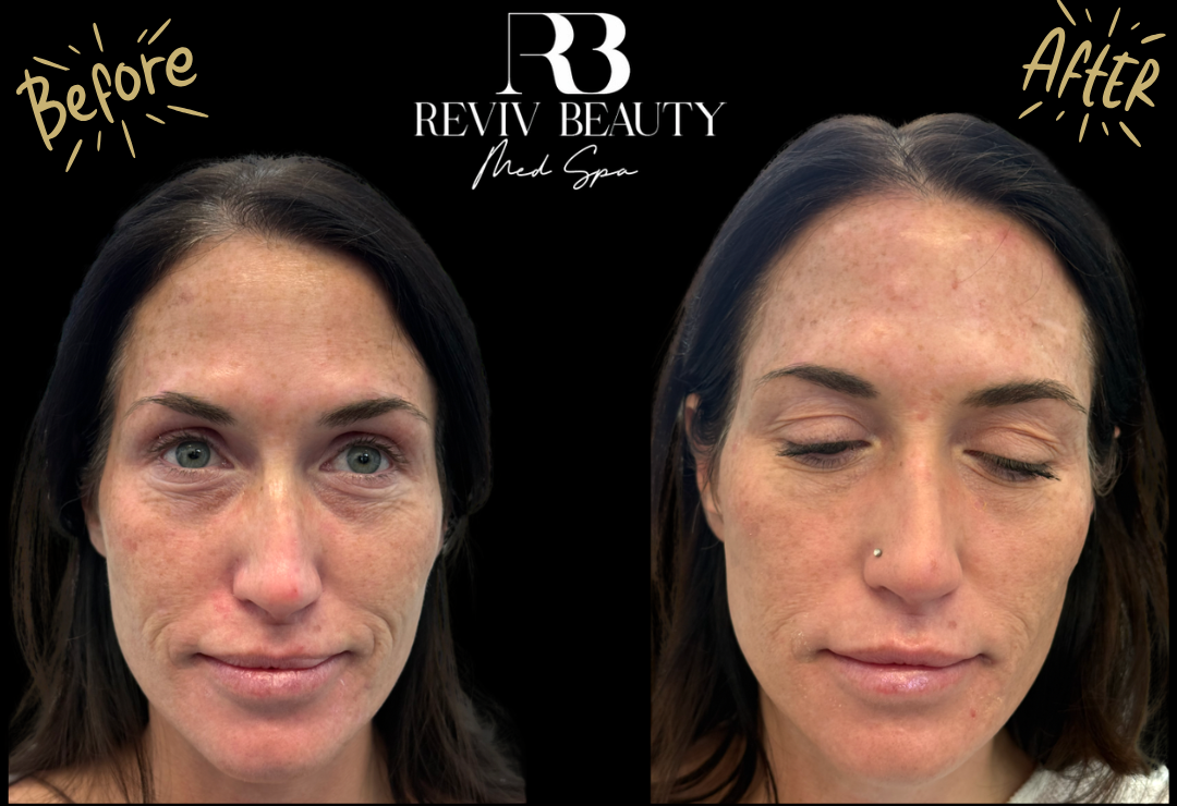 Before and after Bellafill facial balancing treatment — Reviv Beauty Med Spa Sanford FL