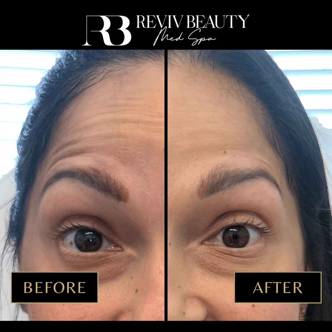 Female patient before and after Botox treatment for raised eyebrows at Reviv Beauty Med Spa in Sanford FL