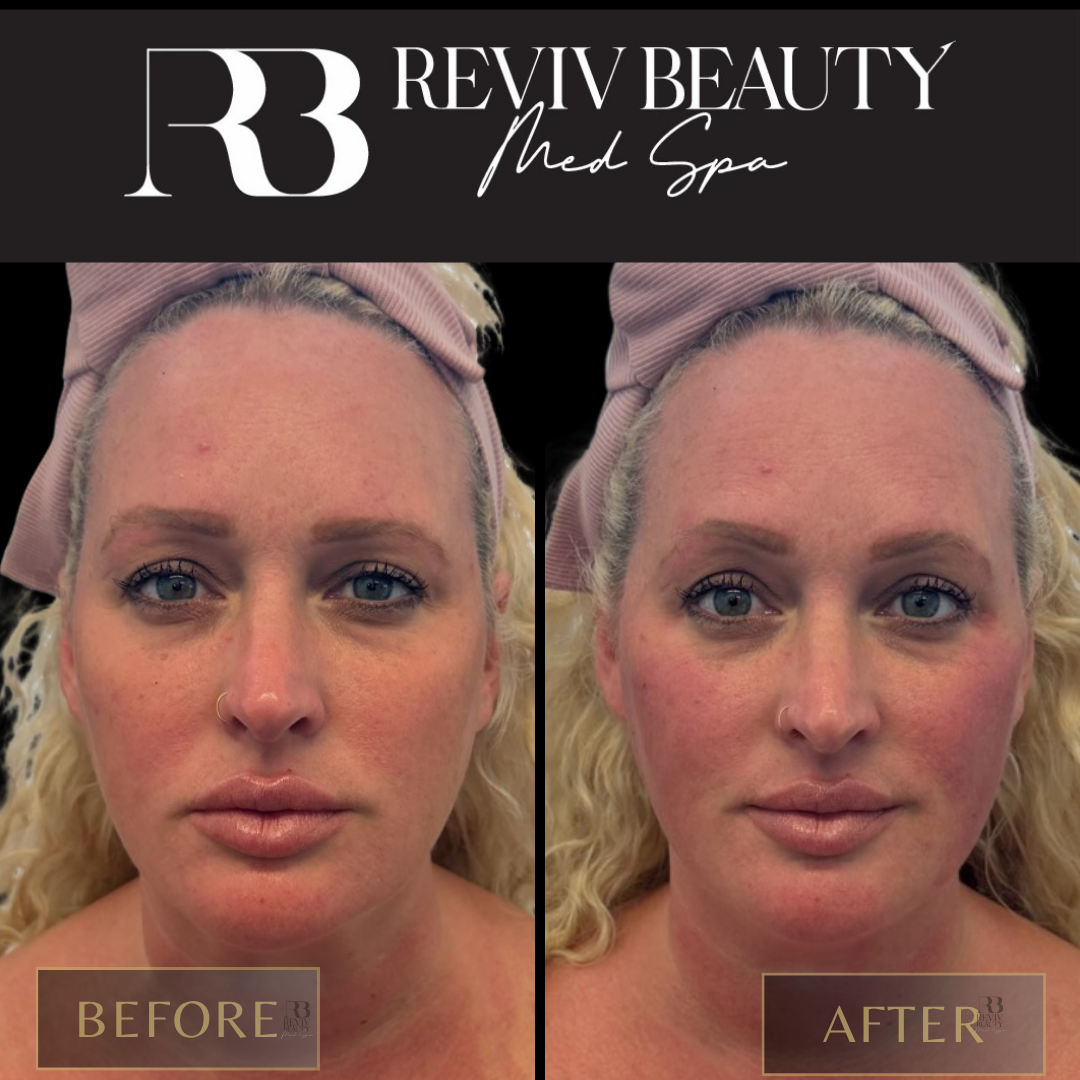 Female patient before and after cheek filler at Reviv Beauty Med Spa in Sanford FL