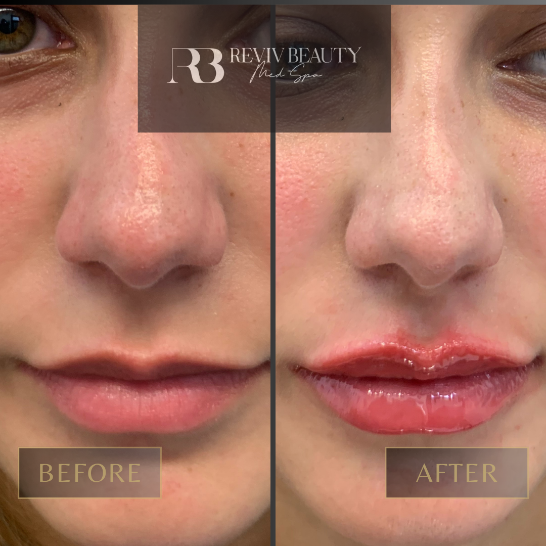 Female patient before and after Juvederm lip filler at Reviv Beauty Med Spa in Sanford FL