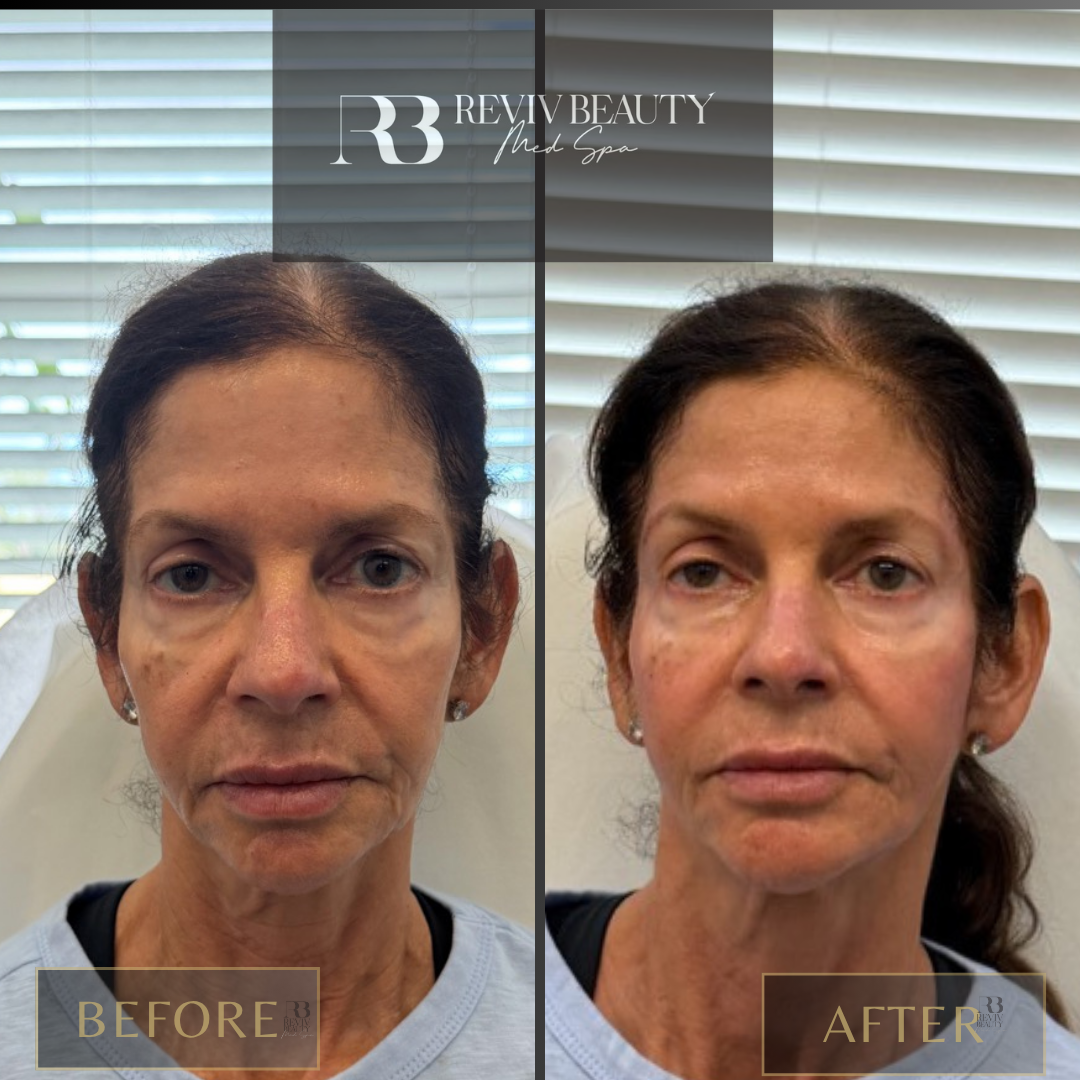 Liquid Facelift Patient before and after at Reviv Beauty Sanford FL
