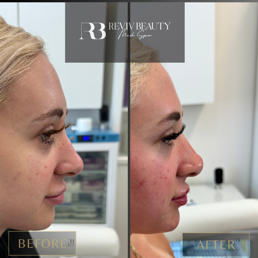 Female patient before and after liquid rhinoplasty at Reviv Beauty Med Spa in Sanford FL